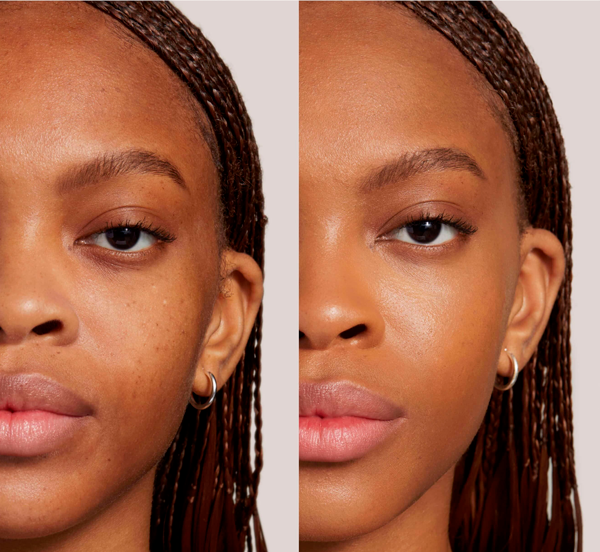 Antes e depois — Hiperpigmentação