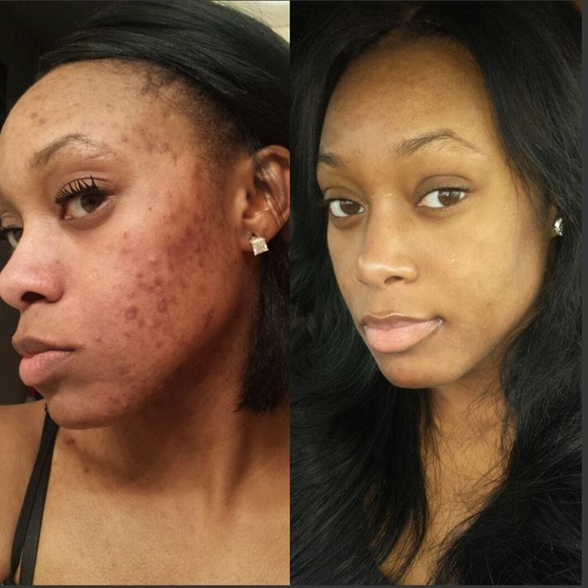 Antes e depois — Manchas